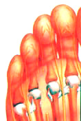 NeuromaF2.JPG (45209 bytes)